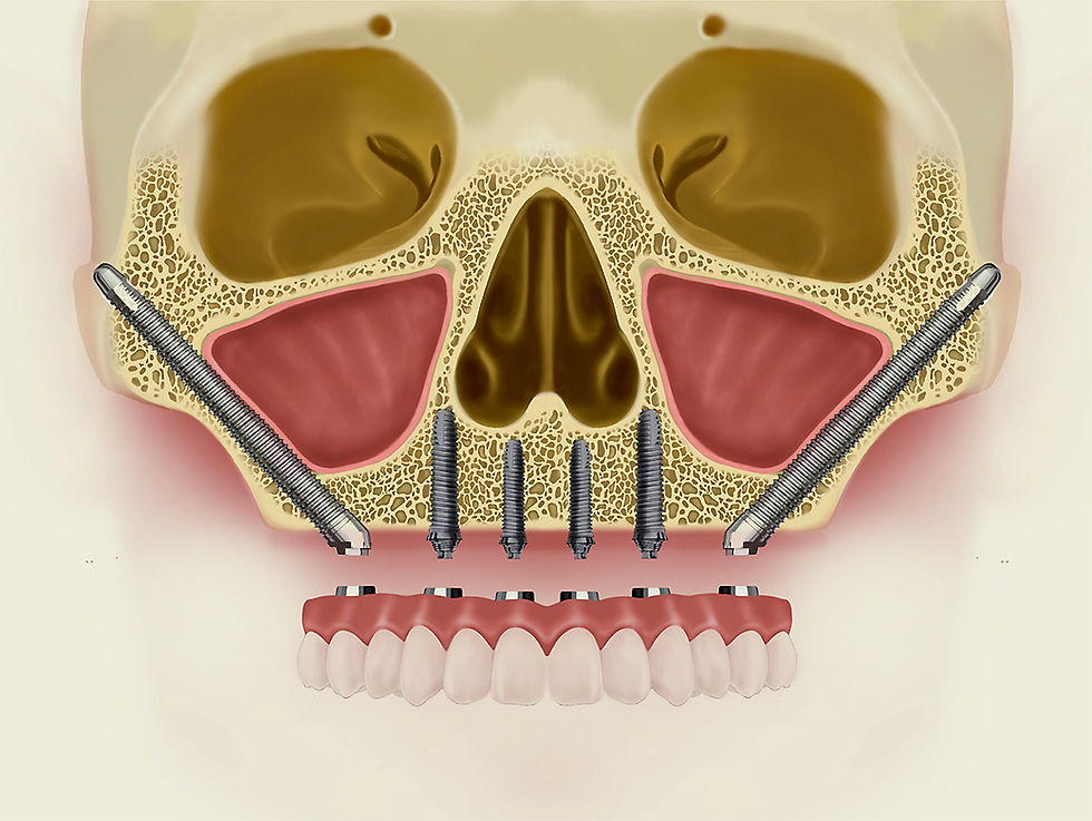 Zigomatik implant uygulaması sırasında elmacık kemiğine sabitleme.