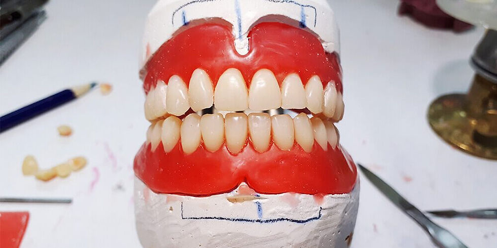 Tam ağız implant tedavisi için yerleştirilen titanyum implantların çene yapısındaki görünümü.