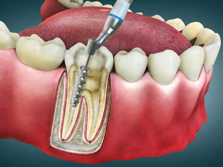 Kanal Tedavisi (Endodonti) Nedir? Oran Çankaya Ankara’da Süreç Nasıl İlerler?