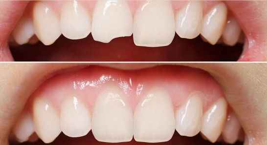 Diş yüzeyine kompozit materyal uygulanarak şekillendirme yapılan bonding işlemi.