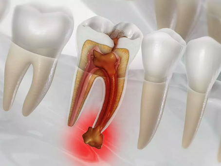 Dental Apse Tedavisi: Oran Çankaya Ankara’da Hızlı ve Etkili Müdahale