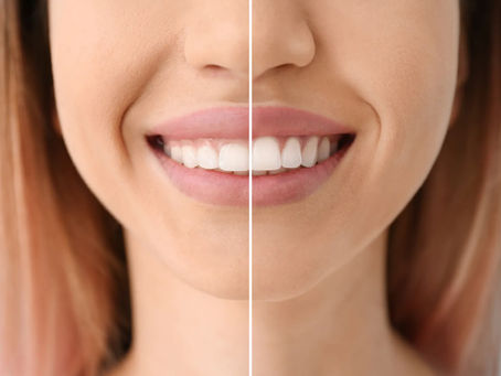 Gummy Smile Nedir? Oran Çankaya Ankara’da Tedavi Yöntemleri