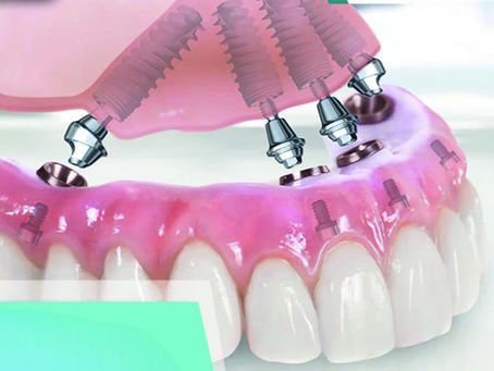 All on Four İmplant Tedavisi: Oran Çankaya Ankara’da Sabit Diş Çözümü