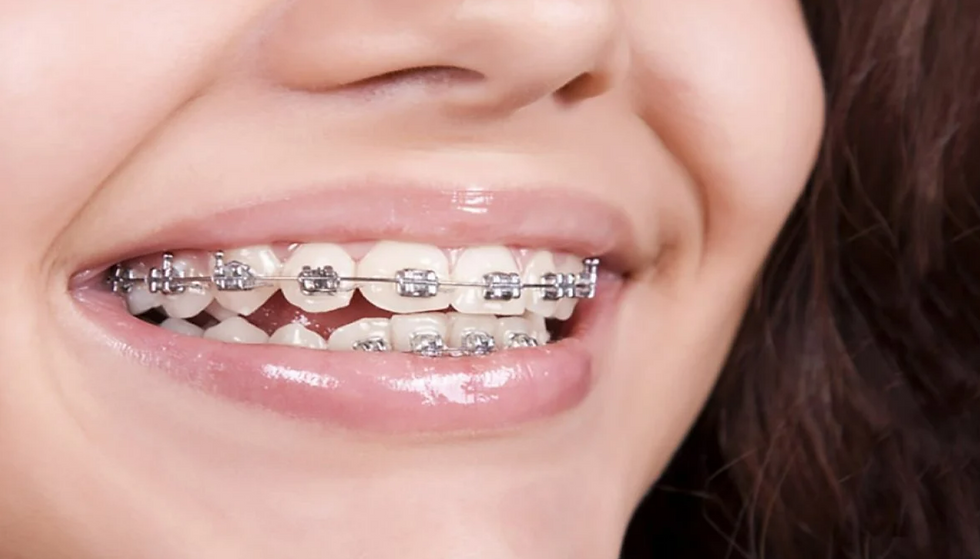 Ortodontik tedavi sonrası düzgün diş dizilimine sahip bir çocuğun gülümsemesi.