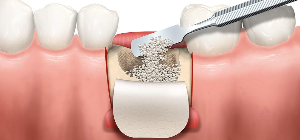 Kemik grefti ile implant öncesi çene kemiği güçlendirme işlemi.