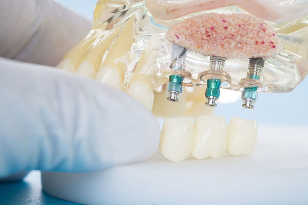 Uzun ömürlü diş implantı uygulaması