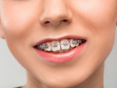 Tel Tedavisi: Oran Çankaya Ankara’da Diş Dizilimi ve Çene Uyumunun Düzenlenmesi