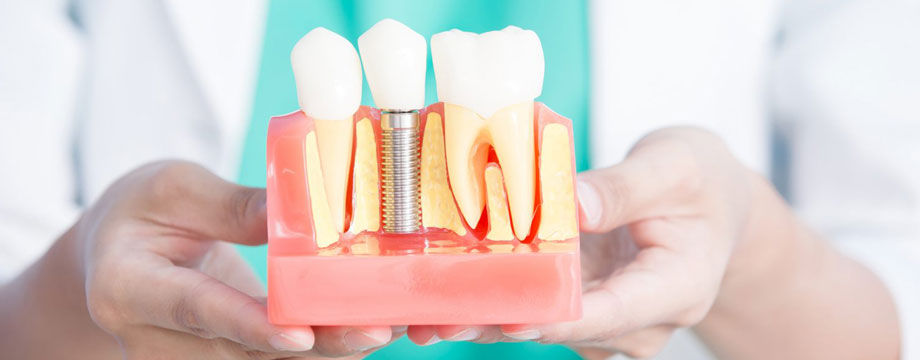 Funda Sarıkaya Polikliniği’nde implant yerleştirme sürecinin klinik görüntüsü.