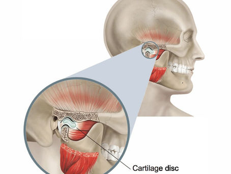 TMJ Bozuklukları Nedir? Belirtileri ve Yaklaşımlar – Oran Çankaya Ankara