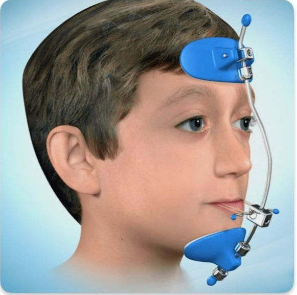 Çene geriliğini gösteren profil görünümüne ait örnek bir görsel.