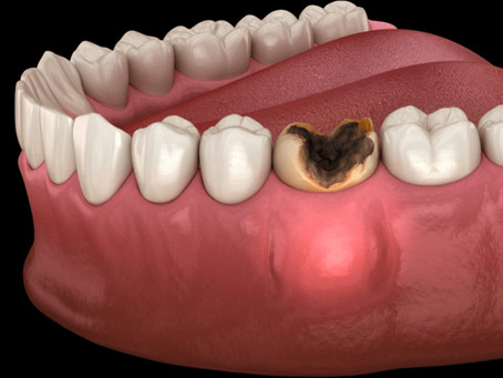 Dental Apse Tedavisi: Oran Çankaya Ankara’da Hızlı ve Etkili Müdahale