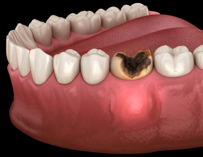Dental apse nedeniyle şişlik oluşmuş bir dişin röntgen görüntüsü