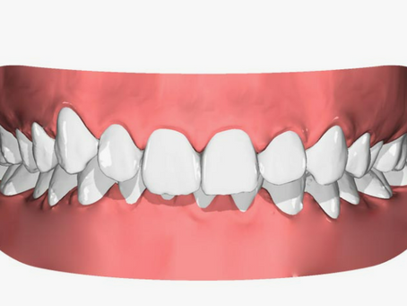 Derin Kapanış (Deep Bite) Nedir? Neden Oluşur ve Nasıl Tedavi Edilir?
