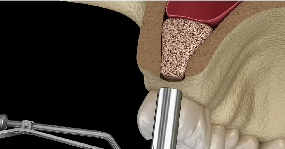 Sinüs kaldırma, üst çene kemiği yetersiz hastalara implant tedavisi için uygulanan cerrahi bir işlemdir.