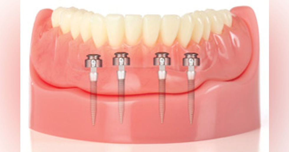 Mini diş implantı uygulamasına hazırlık aşamasını gösteren görsel.
