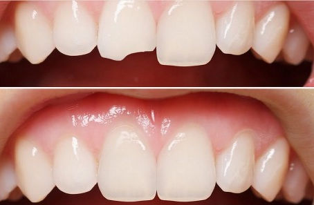 Bonding Nedir? Oran Çankaya Ankara’da Dişlerde Hızlı ve Etkili Estetik Uygulama