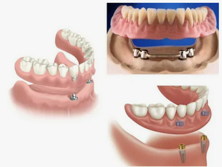 Overdenture Protez Nedir? Oran Çankaya Ankara’da Hareketli Protez Çözümleri