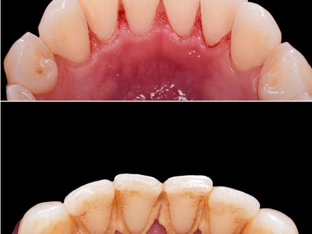 Diş Taşı Temizliği: Oran Çankaya Ankara’da Ağız ve Diş Sağlığının Korunması