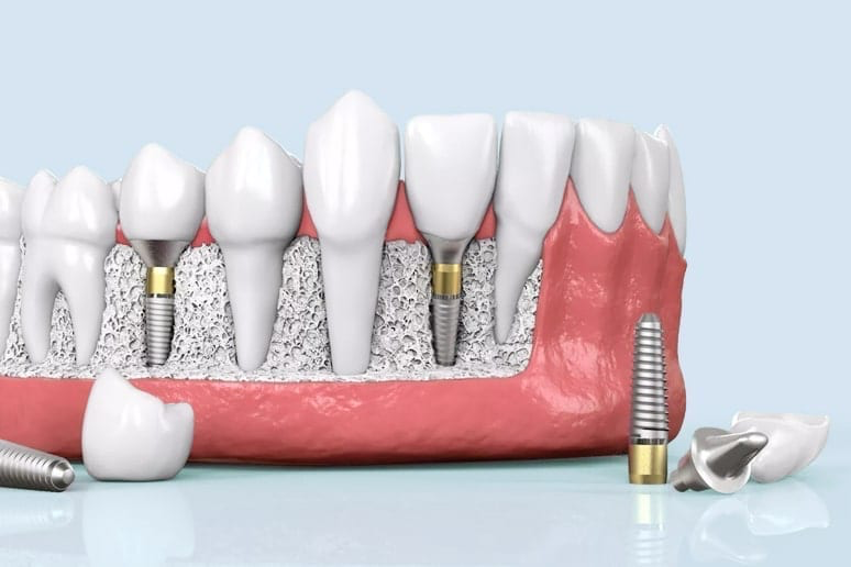 Çene kemiğine yerleştirilmiş bir implantın 3D görselleştirilmiş hali.