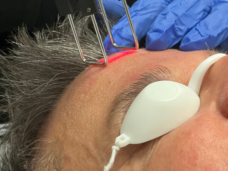 How CoolPeel Helps with Fine Lines, Sun Damage & Texture