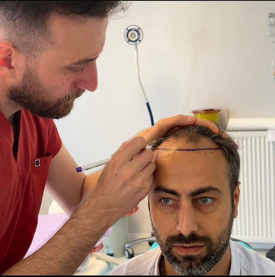 UltraHairTransplant