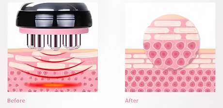 RF Skin Tightening Treatement | Infinite Vibes Body