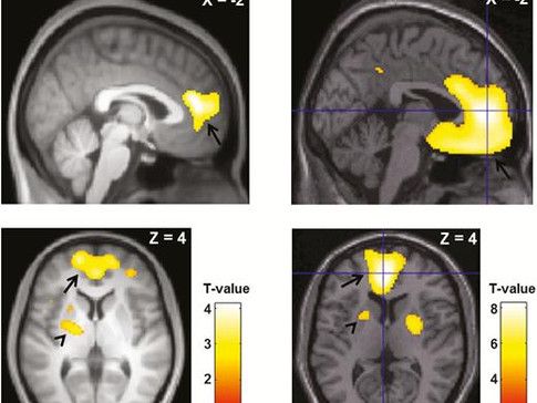 Study suggests possible trait unique to Idiopathic Hypersomnia