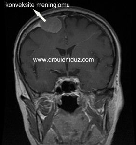 fig-konveksite-meningiomu