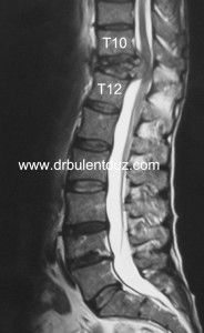 Metastatik Omurga Tümörleri