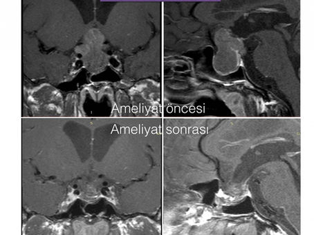 Hipofiz Ameliyat örnekleri