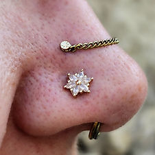 Right view of Healed High Nostril