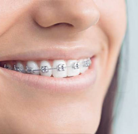 Metal-Dental-Braces.jpg