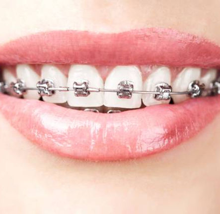 Damon-Braces-System-Dental-Braces.jpg