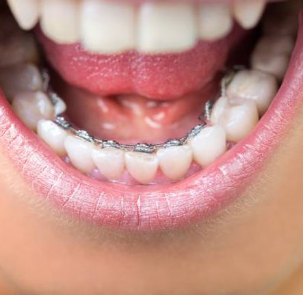 Incognito-Hidden-Braces-Dental-Braces.jpg