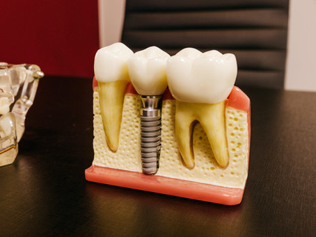How to Care for Your Dental Implant