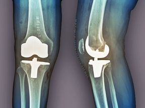 Total Knee Replacement (TKR): How Physiotherapy Leads to Better Recovery