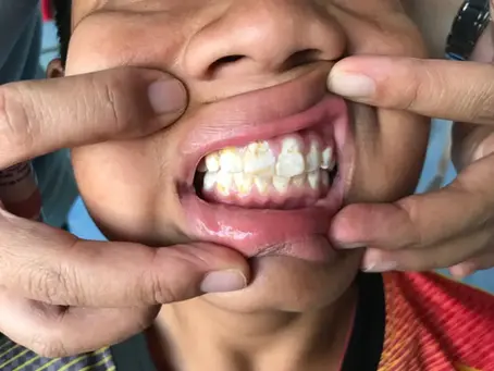 Fluorosis: Ciri-Ciri, Penyebab, dan Cara Mengatasinya