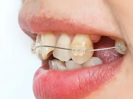 Behel Gigi Gingsul, Apakah Bisa Dilakukan?