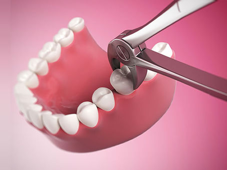 Kapan Waktu yang Tepat Untuk Cabut Gigi ? kenali tandanya ! Dan apa Fungsi, Prosedur, Efek samping ?