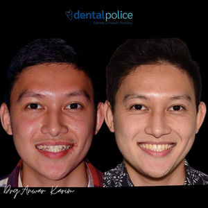 INVISALIGN CAN CHANGE YOUR FACIAL FEATURE