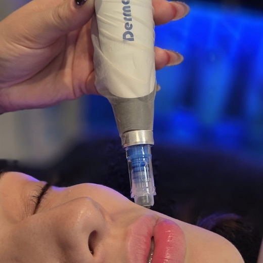 Dermapen