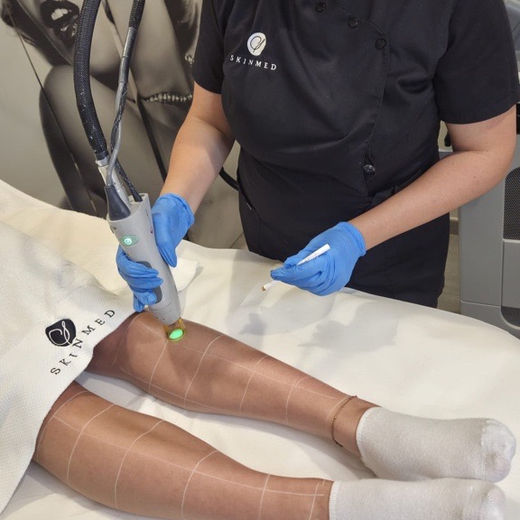 épilation laser