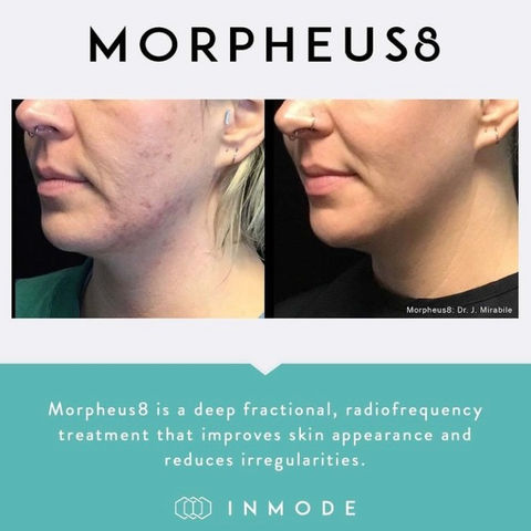 Before and After image of Morpheus8 results.