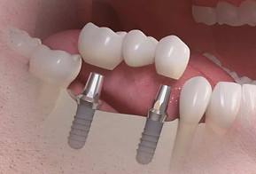 ponte_fixa_sobre_implantes_50kb.jpg