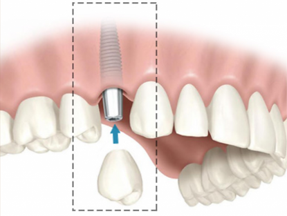 implante dentário_edited.png