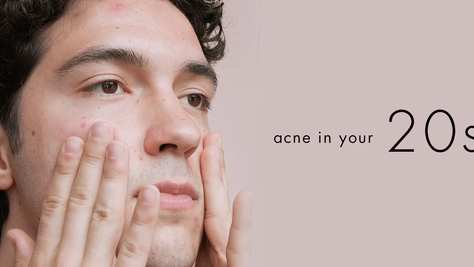 Bioelements acne in your 20s skin care routine for clearer balanced skin.