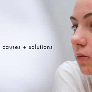 Bioelements teen acne routine for clearer calmer skin.