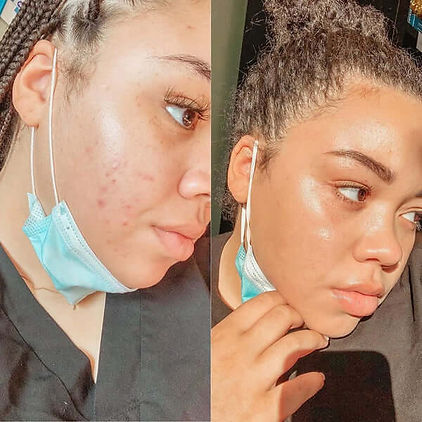 acne-model