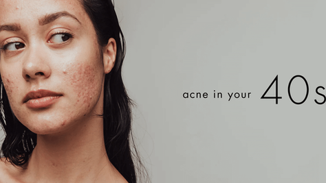 Bioelements acne in your 40s routine for clearer hydrated balanced skin.