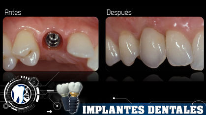 Implantes Dentales Salamanca Guanajuato Mexico Dr. Jesus Omar Noriega Gutierrez Especialis